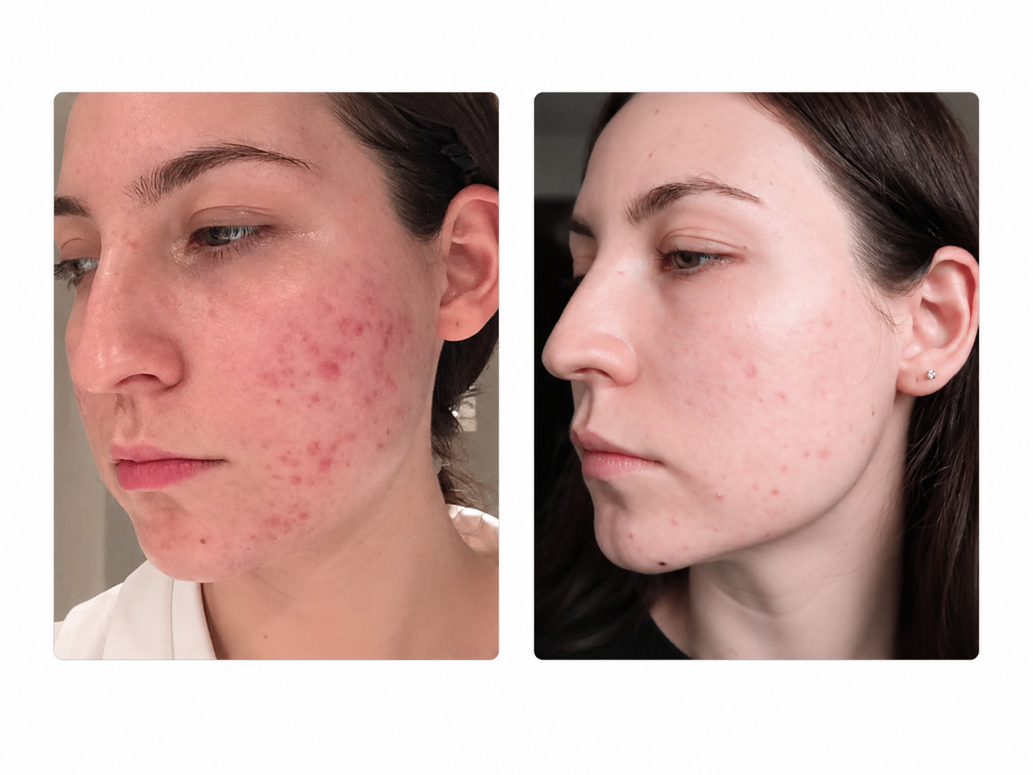 Crème anti-acné 30g – Fini les boutons qui reviennent sans cesse
